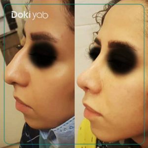 نمونه عمل بینی نچرال حشمت الله حقوقی دکتر عمل بینی در شیراز