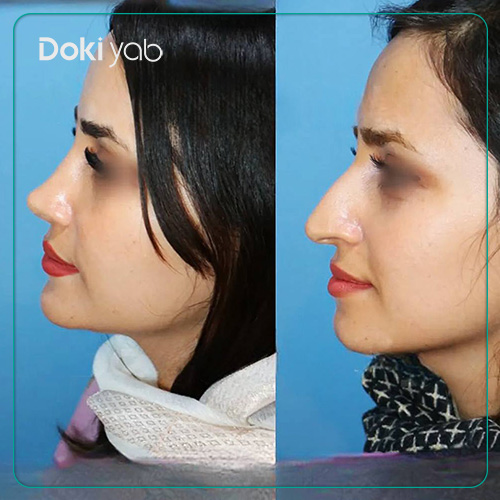نمونه عمل بینی نچرال دکتر داریوش ساریخانی در شیراز