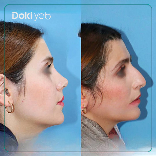 نمونه عمل بینی نیمه فانتزی دکتر داریوش ساریخانی