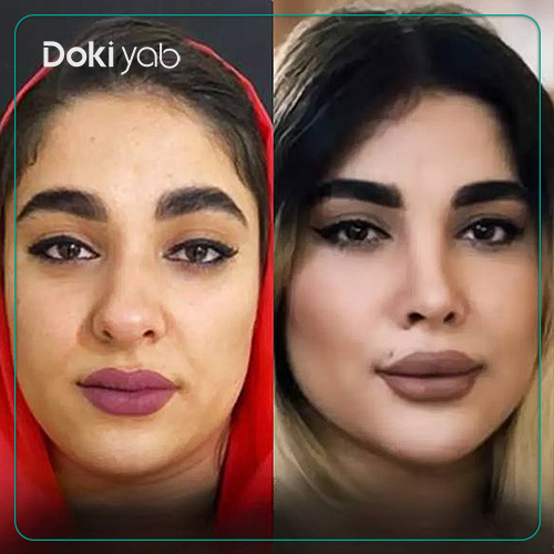 نمونه عمل بینی نیمه فانتزی دکتر زهرا خسروی