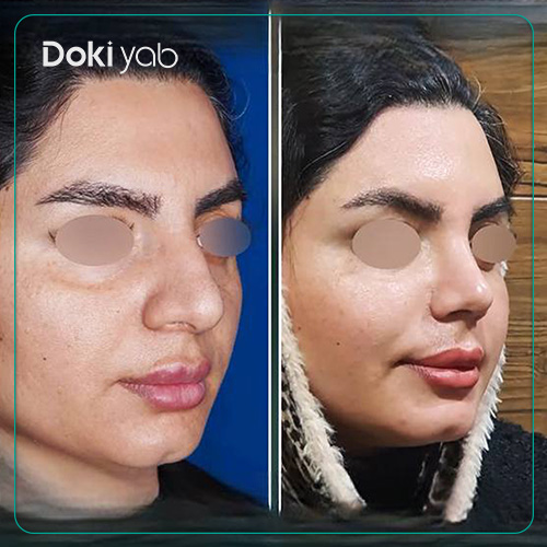 نمونه عمل زیبایی بینی دکتر رضا کبودخانی