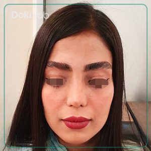 نمونه عمل بینی به سبک نچرال دکتر محمد مهدی ده بزرگی در شیراز