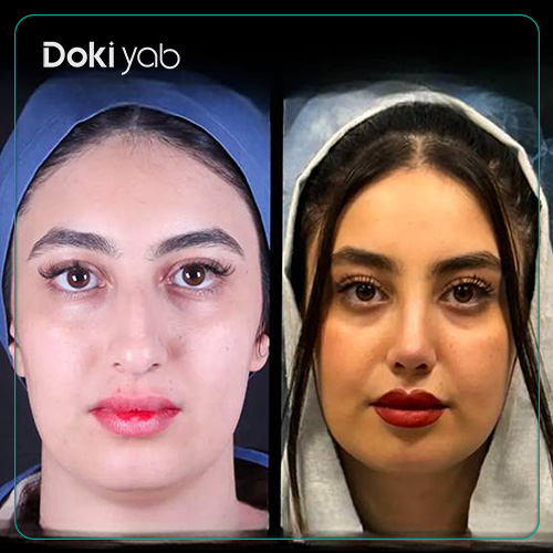 نمونه قبل و بعد عمل بینی طبیعی دکتر سلمان شاکری