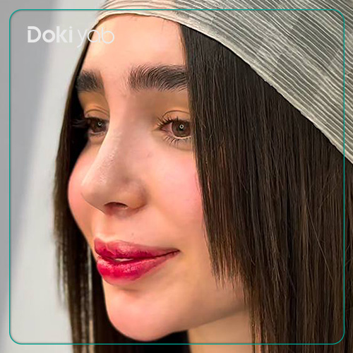 نمونه کار جراحی بینی زنانه به سبک نیمه فانتزی توسط دکتر حامد پوستچی