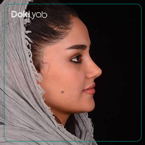 نمونه کار جراحی بینی دکتر حامد پوستچی به سبک نیمه فانتزی