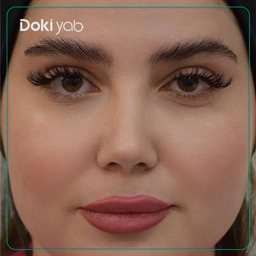 نمونه کار جراحی بینی به سبک طبیعی توسط دکتر حامد پوستچی