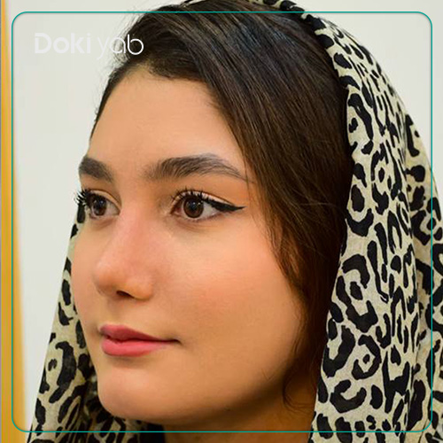 نمونه کار عمل بینی نیمه فانتزی زنانه توسط دکتر حامد پوستچی