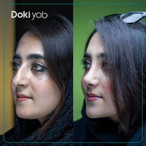 نمونه کار جراحی بینی استخوانی نیمه فانتزی در شیراز با دکی یاب