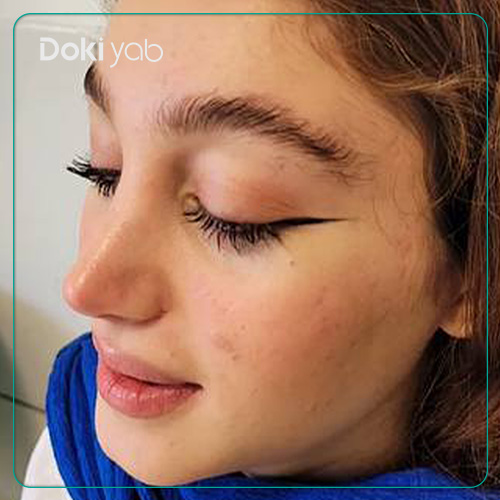 نمونه کار جراحی بینی به سبک طبیعی دکتر شمیلا رضوانی نیا جراح بینی در شیراز