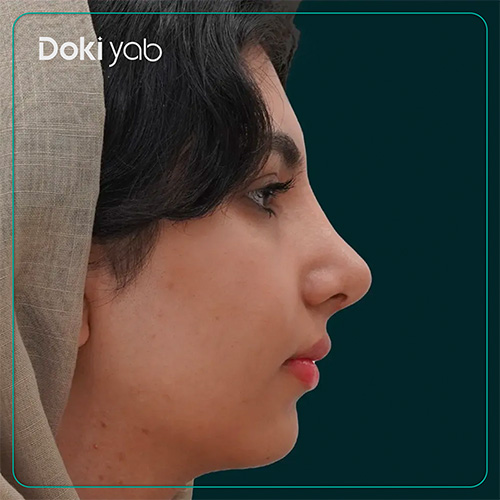 نمونه کار جراحی بینی به سبک طبیعی دکتر محسن روشنی در شیراز
