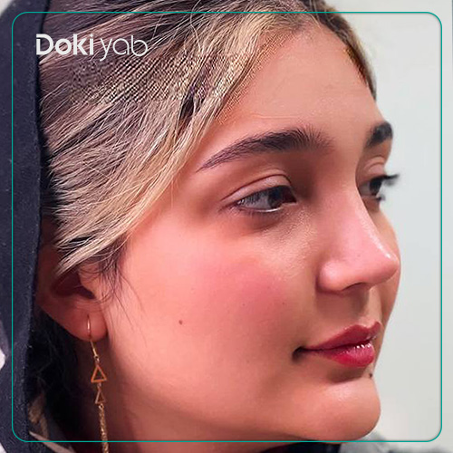 نمونه کار جراحی بینی به سبک نیمه فانتزی توسط دکتر لطفعلی نوروزی جراح بینی در شیراز