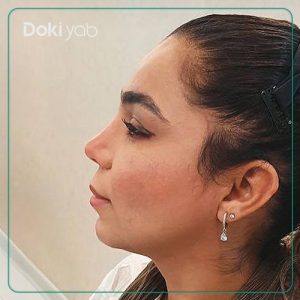 نمونه کار جراحی بینی به سبک نیمه فانتزی توسط دکتر محمد مهدی ده بزرگی