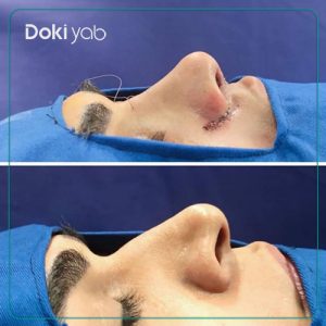 نمونه کار جراحی بینی به سبک نیمه فانتزی دکتر اردلان دهقانی جراح بینی در شیراز