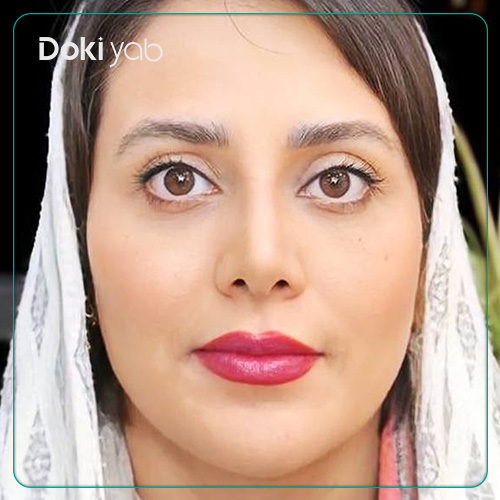 نمونه کار جراحی بینی به سبک نیمه فانتزی دکتر مسیح طالع