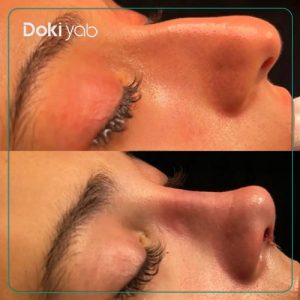 نمونه کار جراحی بینی دکتر اردلان دهقانی جراح بینی در شیراز