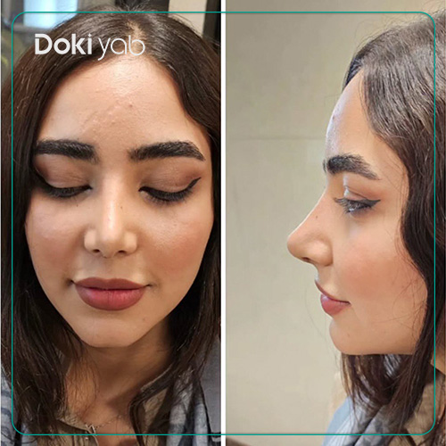 نمونه کار جراحی بینی دکتر امیر خسرو برخورداری به سبک طبیعی