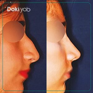 نمونه کار جراحی بینی دکتر بیژن ربیعی جراح بینی در شیرازَ