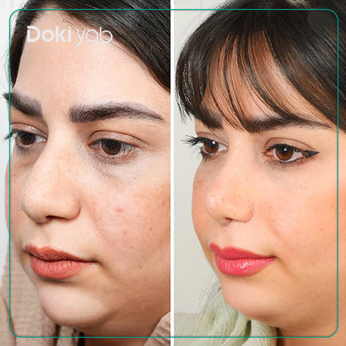 نمونه کار جراحی بینی دکتر حسین دستغیب به سبک نیمه فانتزی