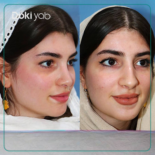 نمونه کار جراحی بینی دکتر داریوش ساریخانی به سبک نیمه فانتزی