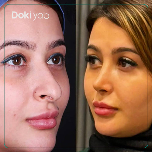 نمونه کار جراحی بینی دکتر دکتر سلمان شاکری به سبک طبیعی در شیراز