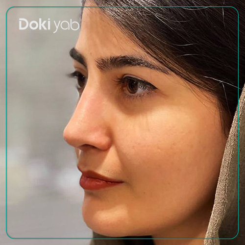 نمونه کار جراحی بینی دکتر علیرضا مصباحی به سبک نچرال