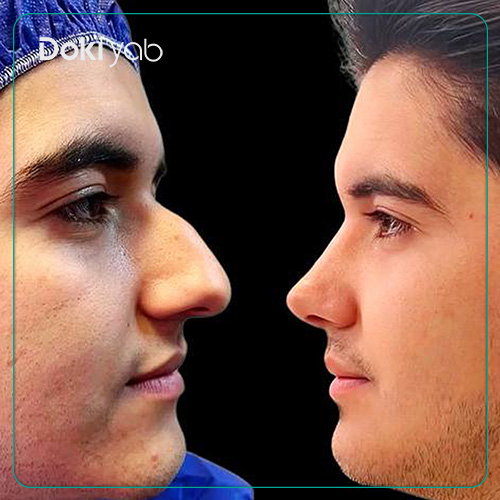 نمونه کار جراحی بینی دکتر مجتبی قائدی جراح بینی در شیراز