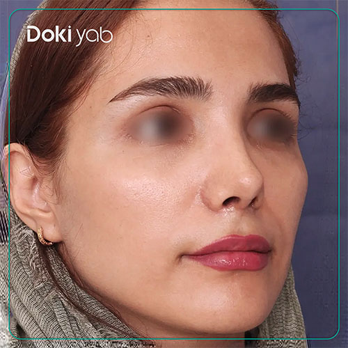 نمونه کار جراحی بینی دکتر محسن روشنی جراح بینی در شیراز