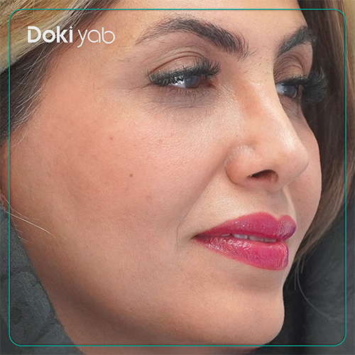 نمونه کار جراحی بینی دکتر محسن روشنی در شیراز