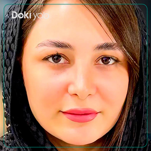 نمونه کار جراحی بینی زنانه دکتر آمیتیس نوذری جراح بینی در شیراز