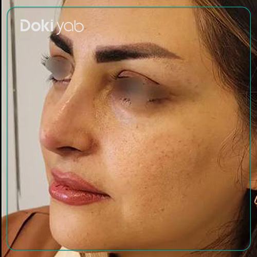 نمونه کار جراحی بینی زنانه دکتر شمیلا رضوانی نیا جراح بینی در شیراز