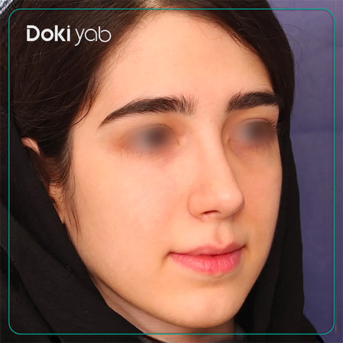 نمونه کار جراحی بینی زنانه دکتر محسن روشنی در شیراز