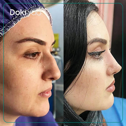 نمونه کار جراحی بینی زنانه نیمه فانتزی دکتر وحید عین آبادی در شیراز