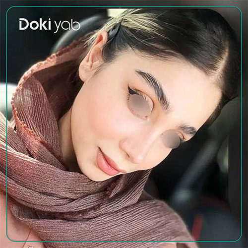 نمونه کار جراحی بینی طبیعی دکتر دنیا کرمی در شیراز
