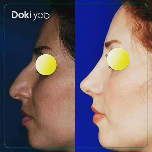 نمونه کار جراحی بینی طبیعی دکتر سعید مرزبان جراح بینی در شیراز
