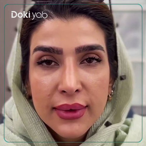 نمونه کار جراحی بینی طبیعی دکتر لیلا شریفی در شیراز