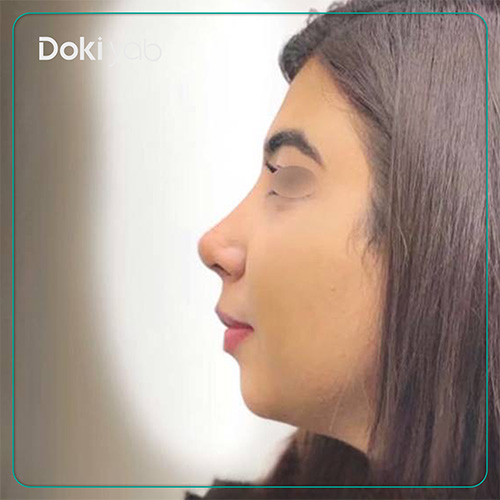 نمونه کار جراحی بینی عروسکی دکتر دنیا کرمی در شیراز