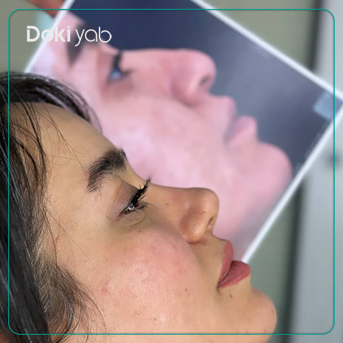 نمونه کار جراحی بینی فانتزی دکتر آمیتیس نوذری در شیراز