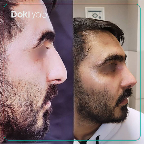 نمونه کار جراحی بینی مردانه طبیعی دکتر شمیلا رضوانی نیا جراح بینی در شیراز
