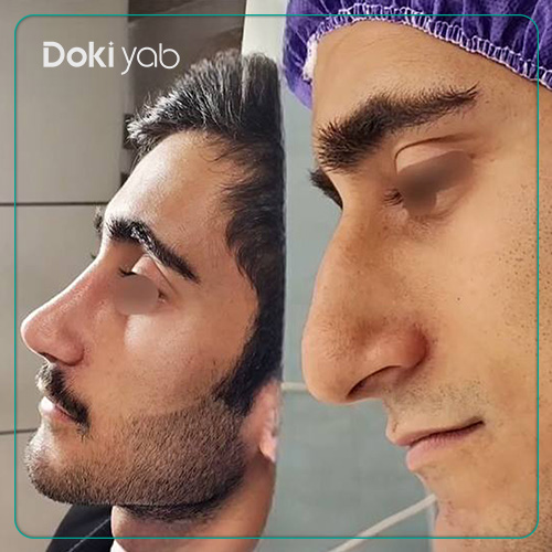 نمونه کار جراحی بینی مردانه دکتر شمیلا رضوانی نیا جراح بینی در شیراز