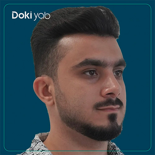 نمونه کار جراحی بینی مردانه دکتر محسن روشنی جراح بینی در شیراز