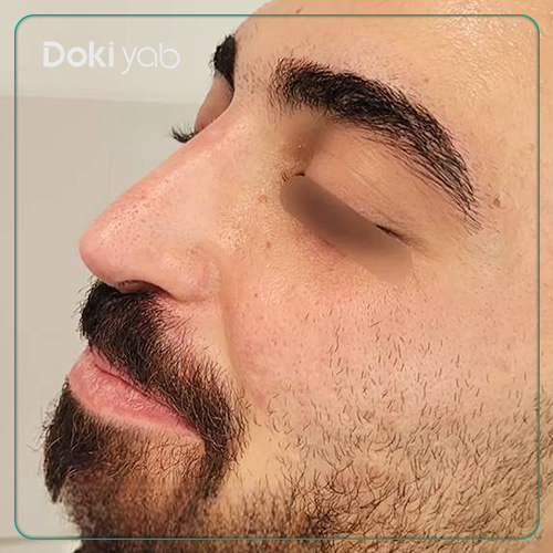نمونه کار جراحی بینی مردانه طبیعی دکتر شمیلا رضوانی نیا جراح بینی در شیراز