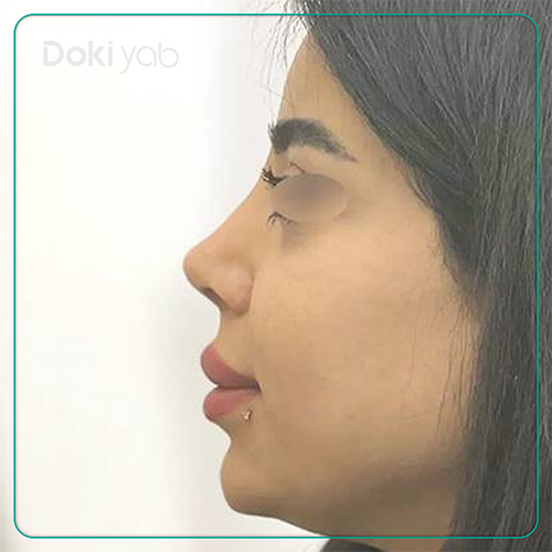 نمونه کار جراحی بینی نیمه فانتزی دکتر دنیا کرمی در شیراز
