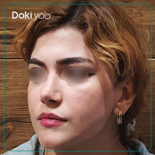نمونه کار جراحی بینی طبیعی دکتر رضا کبودخانی در شیراز