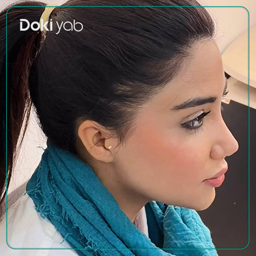 نمونه کار جراحی بینی نیمه فانتزی دکتر شهریار شاهمرادی