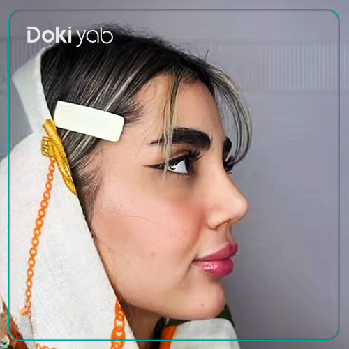 نمونه کار جراحی بینی نیمه فانتزی دکتر لیلا اسدپور