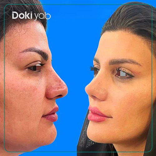 نمونه کار جراحی بینی نیمه فانتزی دکتر مجتبی قائدی در شیراز