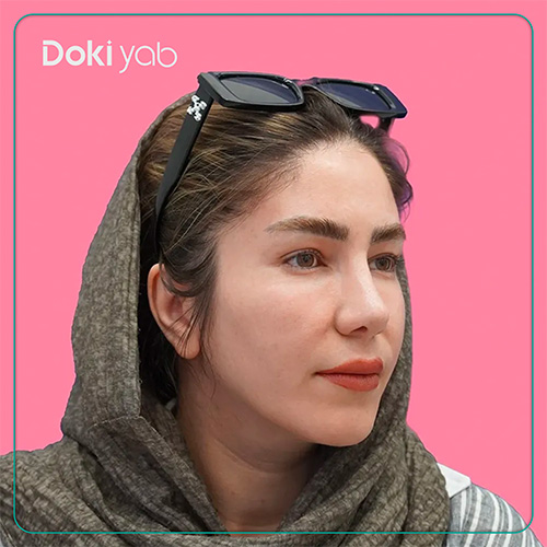 نمونه کار جراحی بینی نیمه فانتزی دکتر محسن روشنی شیراز