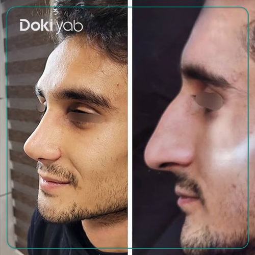 نمونه کار جراحی بینی نیمه فانتزی مردانه دکتر شمیلا رضوانی نیا جراح بینی در شیراز
