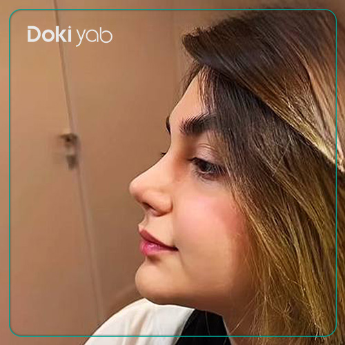 نمونه کار رینوپلاستی دخترانه دکتر لیلا اسدپور جراح بینی در شیراز