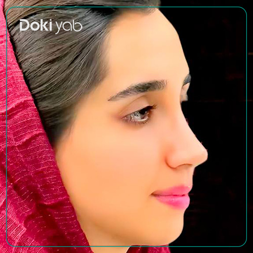 نمونه کار رینوپلاستی دکتر آمیتیس نوذری جراح بینی در شیراز